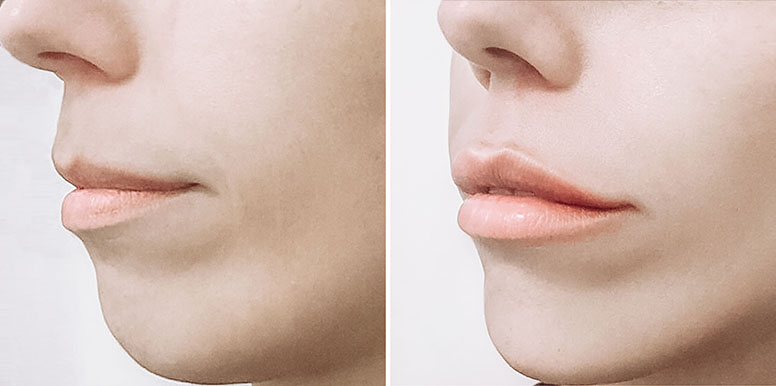 Что такое коррекция формы губ (хейлопластика)